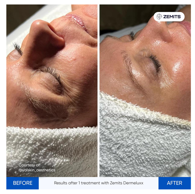 Hydra Facial before and after